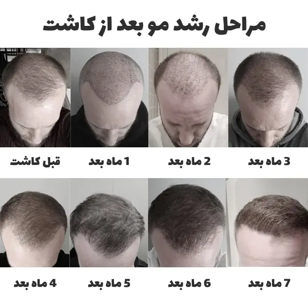 کاشت مو