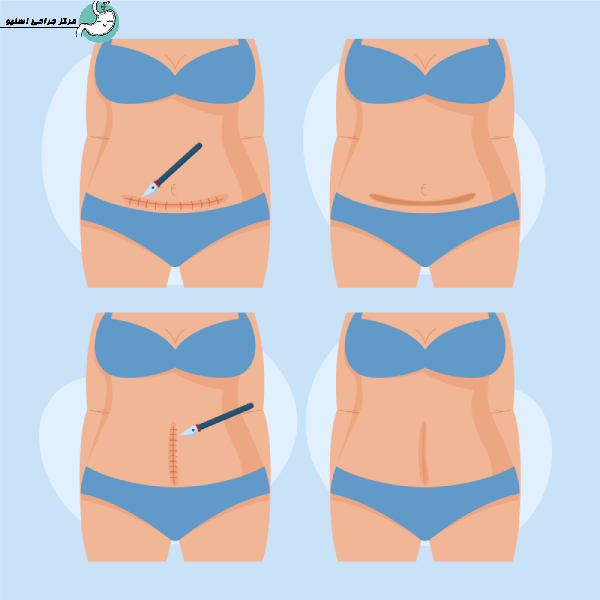 ابدومینوپلاستی برای مادران