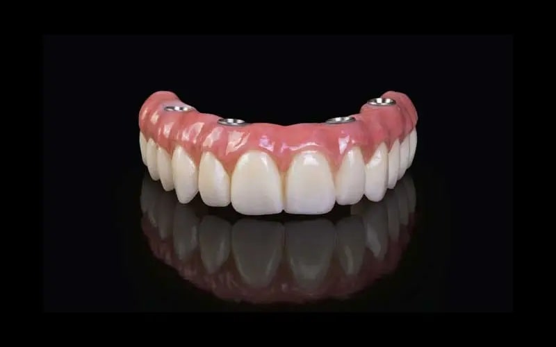 ایمپلنت فوری در تهران