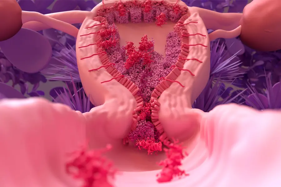 پریود نامنظم: علت، تشخیص و راههای موثر درمان و مدیریت