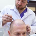 جدیدترین متد کاشت مو در کشور