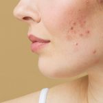 آکنه چیست؟ انواع آکنه و راه حل درمانی آن