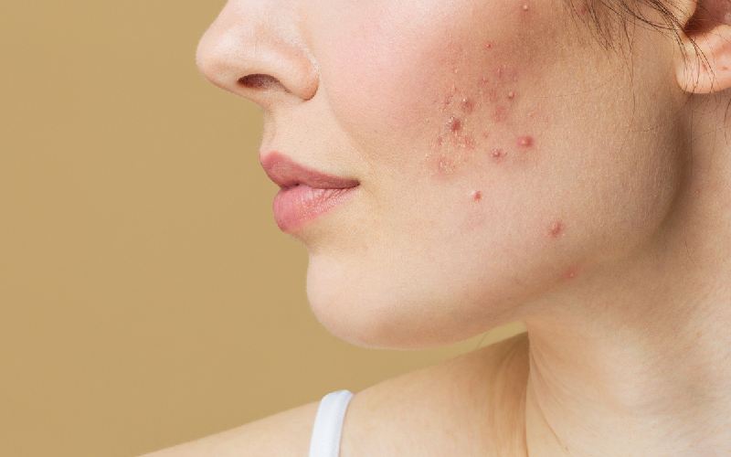 آکنه چیست؟ انواع آکنه و راه حل درمانی آن