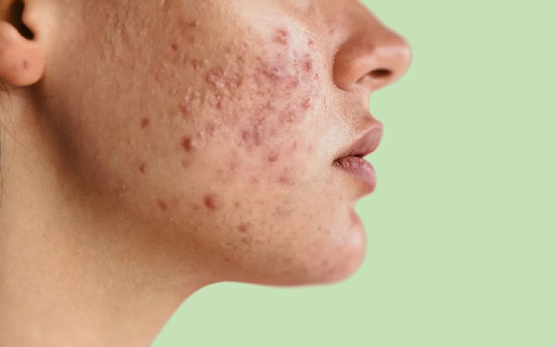 آکنه چیست؟ انواع آکنه و راه حل درمانی آن