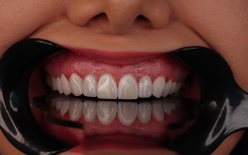 کامپوزیت دندان: کاربرد، انواع، مزایا و مراقبت برای لبخندی درخشان