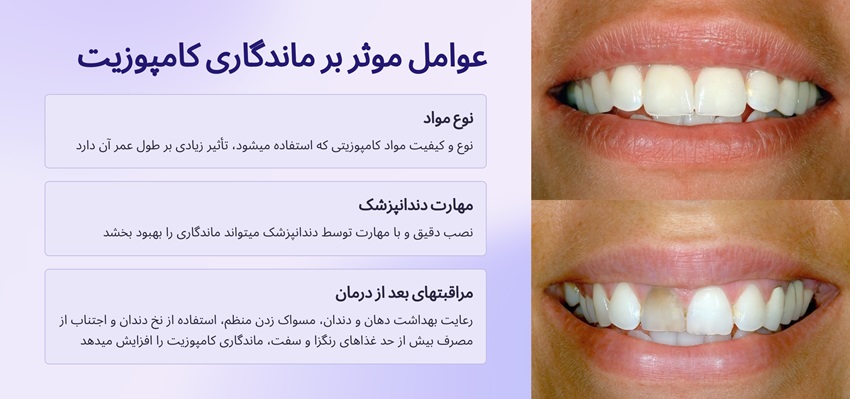 کامپوزیت دندان: کاربرد، انواع، مزایا و مراقبت برای لبخندی درخشان