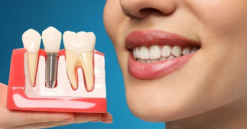 ایمپلنت دندان: راهنمای کامل کاشت، انواع، مزایا و هزینه