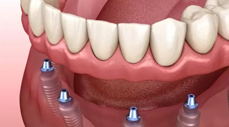 ایمپلنت دندان: راهنمای کامل کاشت، انواع، مزایا و هزینه