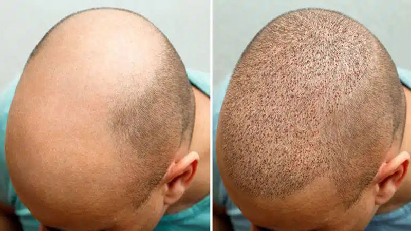 بهترین روش کاشت مو در سال ۱۴۰۴