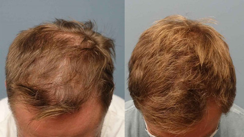 مراقبت‌های ماه اول بعد از کاشت مو