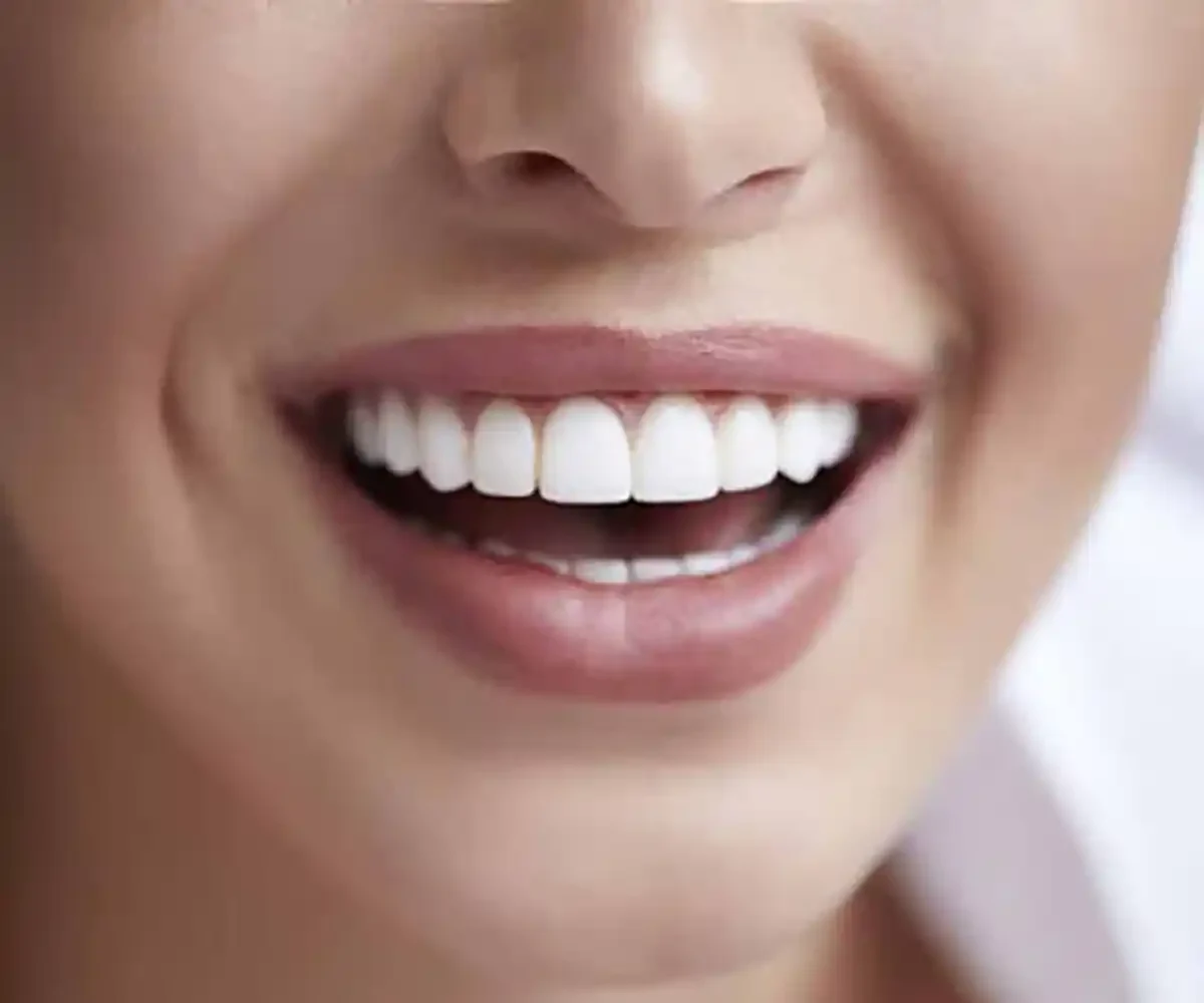 کامپوزیت دندان: کاربرد، انواع، مزایا و مراقبت برای لبخندی درخشان