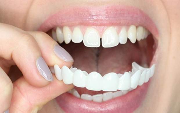 لمینت دندان