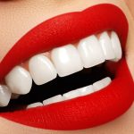 لمینت دندان