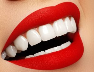 لمینت دندان