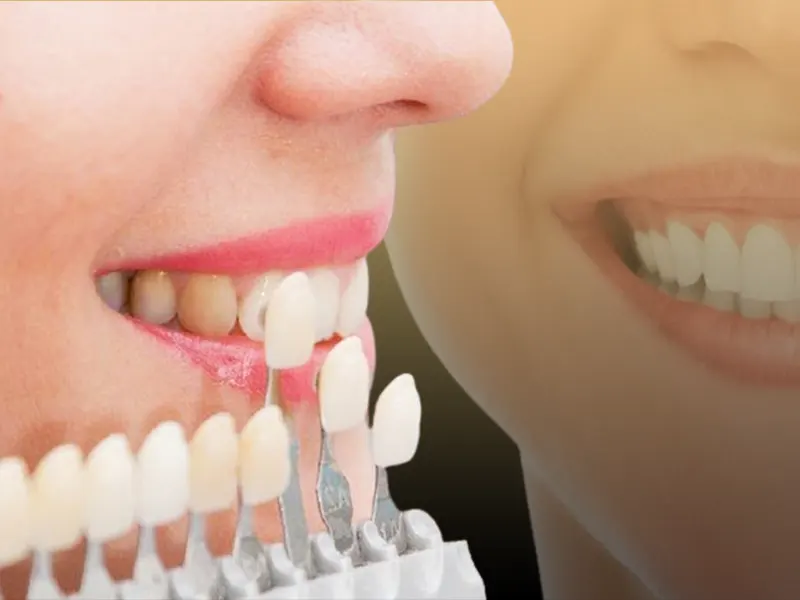 لمینت دندان