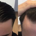 کاشت مو چیست؟