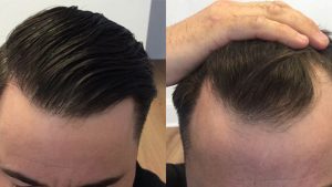 کاشت مو چیست؟