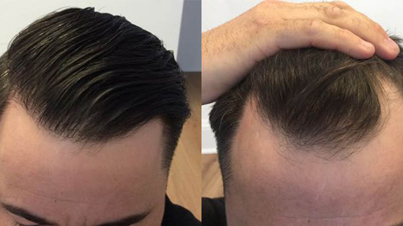 کاشت مو چیست؟