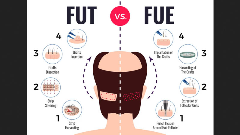 تفاوت روش FIT و FUT کاشت مو