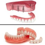 دندان مصنوعی معمولی در مقابل اوردنچر