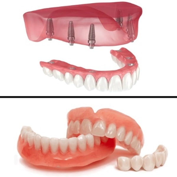 دندان مصنوعی معمولی در مقابل اوردنچر