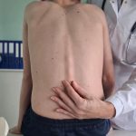 درمان اسکولیوز بدون جراحی