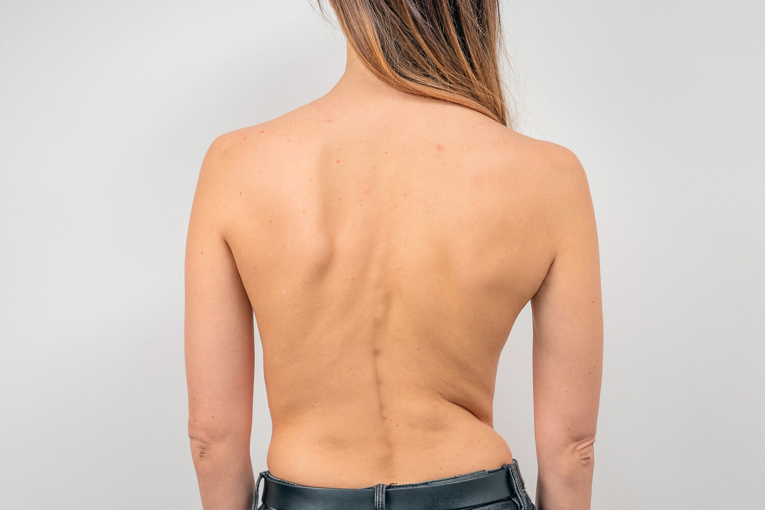 اسکولیوز چگونه تشخیص داده می شود