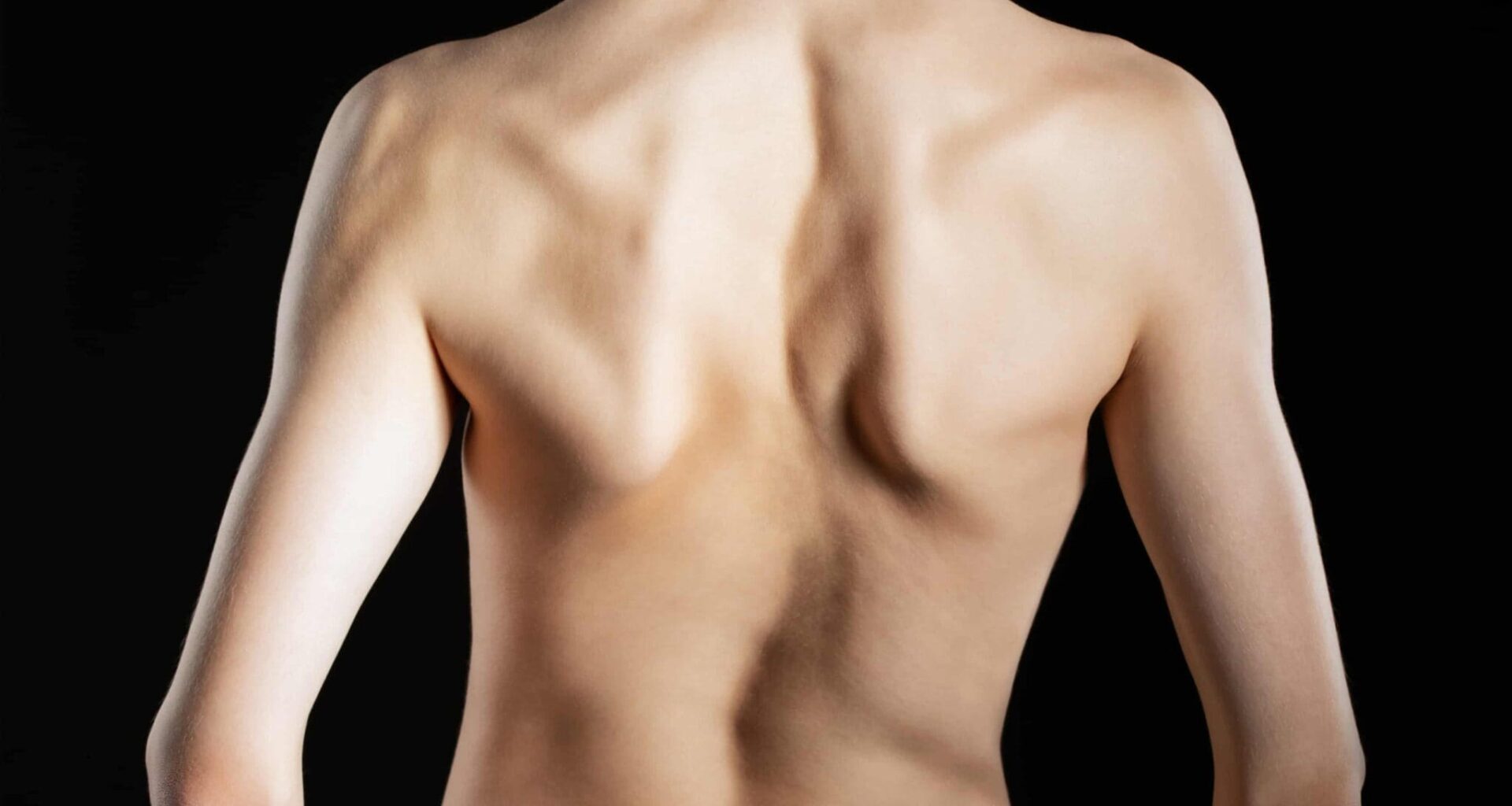 درمان اسکولیوز