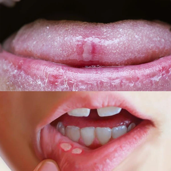مقایسه جوش روی زبان و تاول دهان