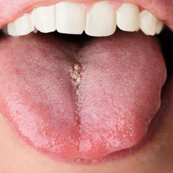 جوش روی زبان