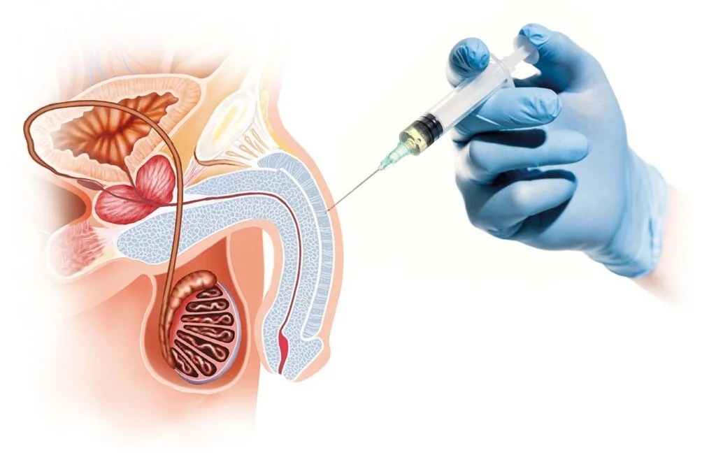 هزینه تزریق به آلت مردان