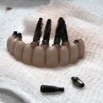 آیا ایمپلنت هم خراب میشود؟