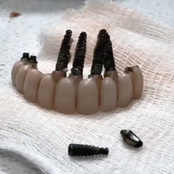 آیا ایمپلنت هم خراب میشود؟