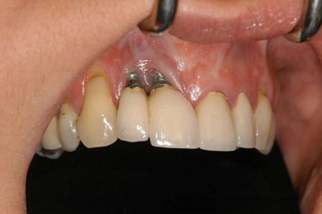 علائم خراب شدن ایمپلنت