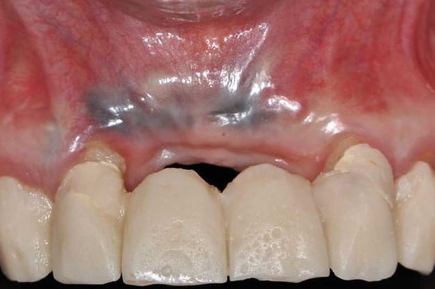 چگونه از خراب شدن دندان ایمپلنت شده جلوگیری کنیم