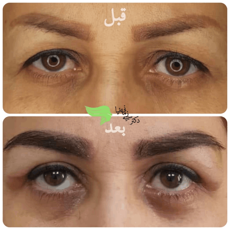 عمل بلفاروپلاستی