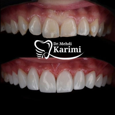 نمونه کار دندان زیبایی در تهران، دکتر مهدی کریمی